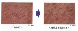 「Ｋ・リゾレシチンクリーム」継続塗布における肌荒れ改善写真