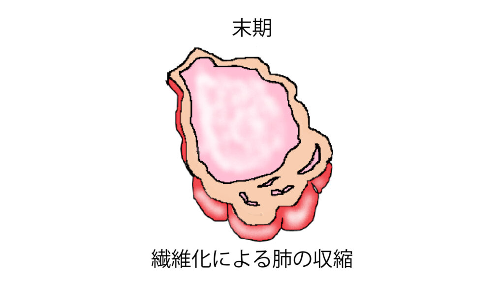 繊維化による肺の収縮